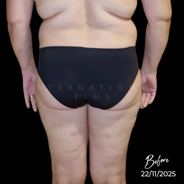 Feeding the Fat Best Diet for BBL Recovery