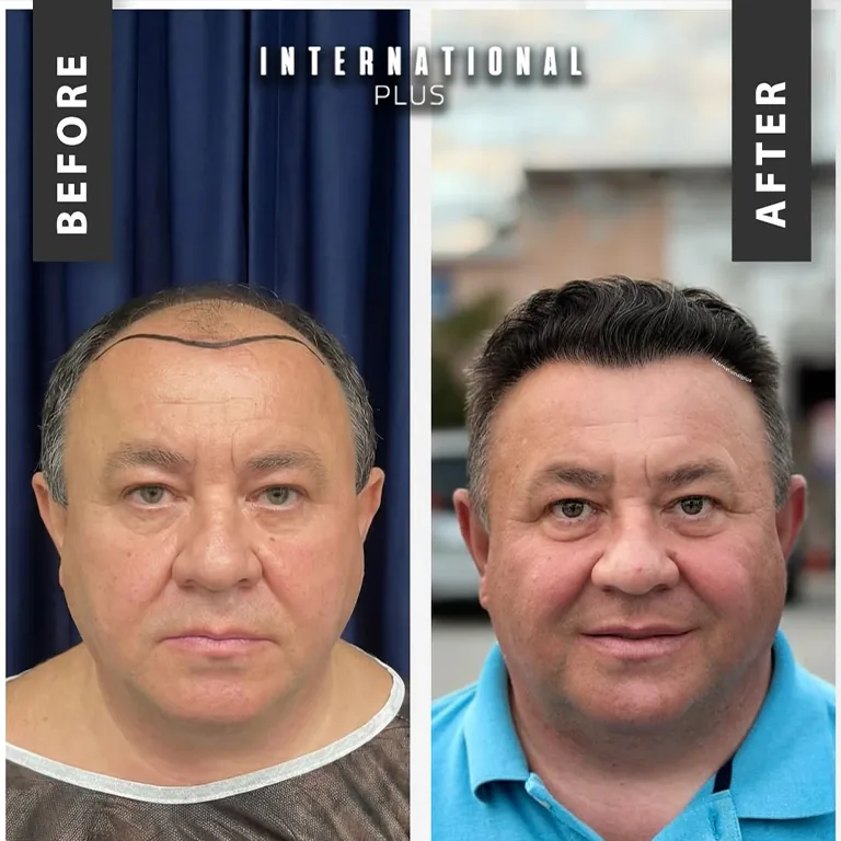 Hair Transplant Recovery Timeline