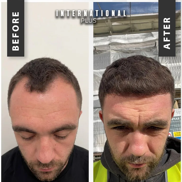 Hair Transplant Scab Shedding Process