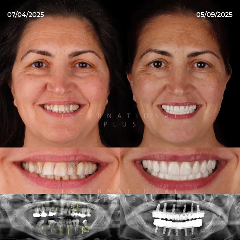 How Long Does Pain Last After Dental Implant