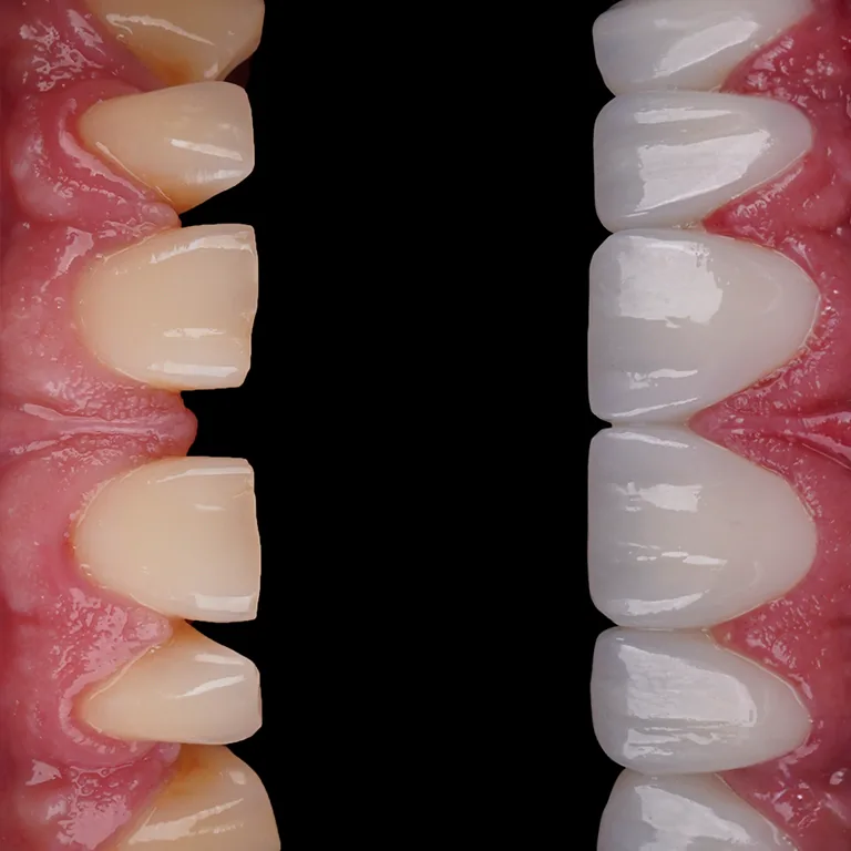 How to Avoid Dental Implant Infection (Peri-implantitis)