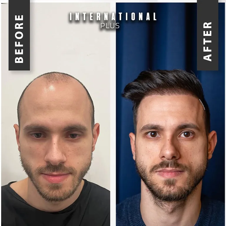 How to Speed Up Hair Transplant Recovery