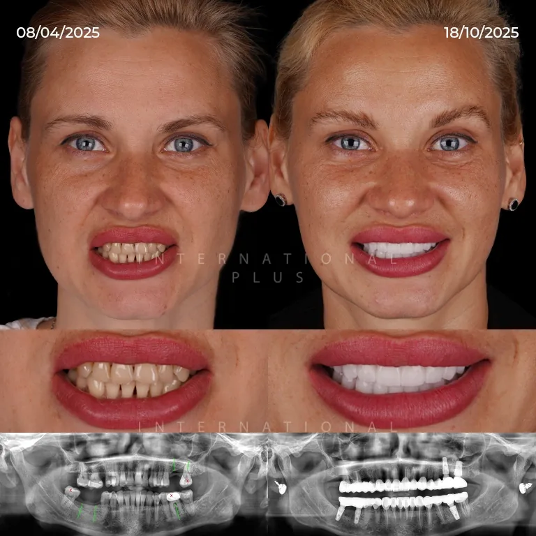 Managing Dental Implant Discomfort Day by Day