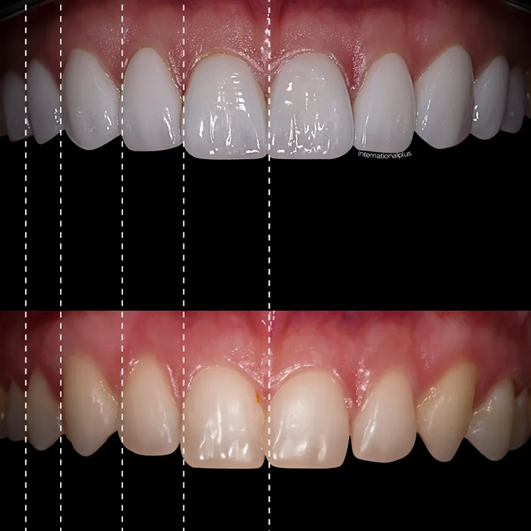 Managing Gum Tenderness and Bite Adjustment