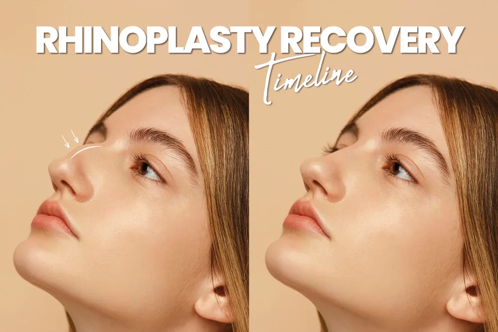 Rhinoplasty Recovery Timeline
