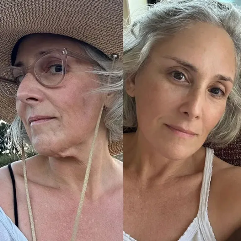 Ricki Lake CO2 Laser Treatment