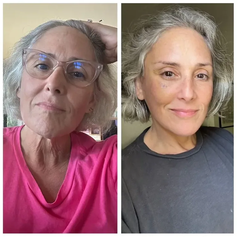 Ricki Lake Deep Plane Facelift Details