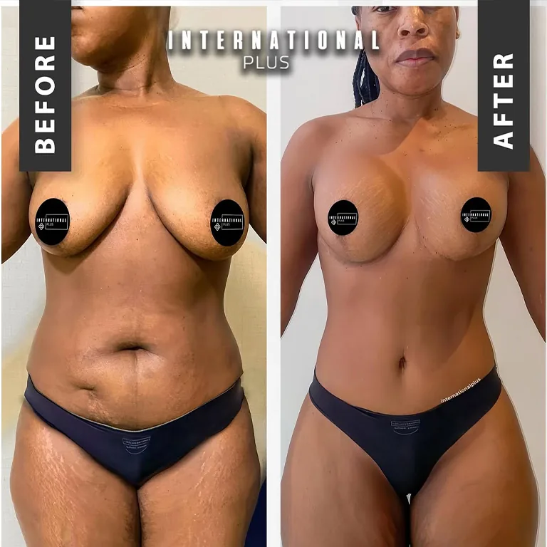 The Impact of BMI on Implant Projection