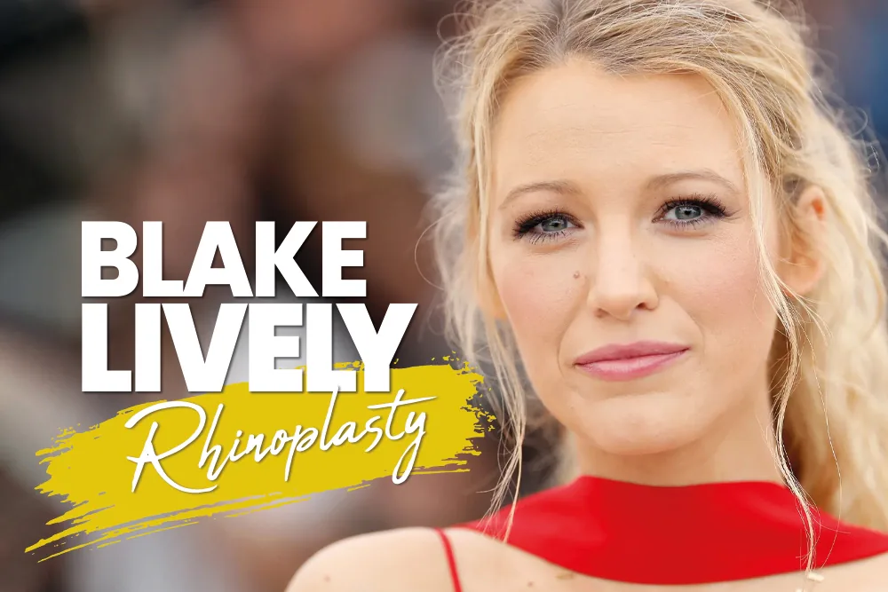 Blake Lively Rhinoplasty: The Gold Standard of Facial Refinement 2026