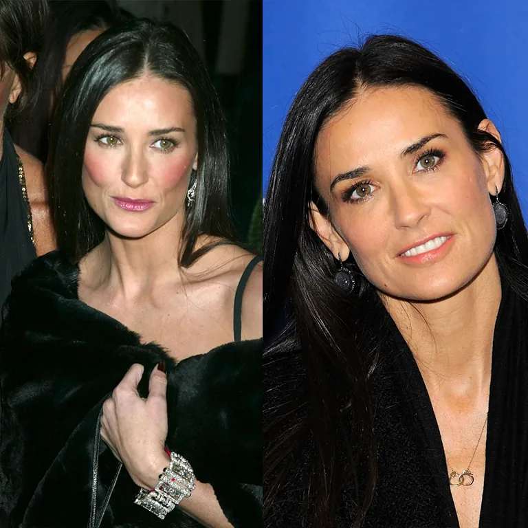 Demi Moore's 2026 Oscars Face Facelift, Brow Lift, and Blepharoplasty