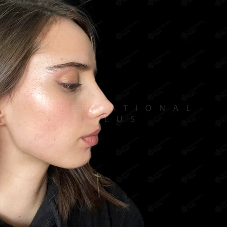 Nose Job Cost in USA vs. UK vs. Turkey