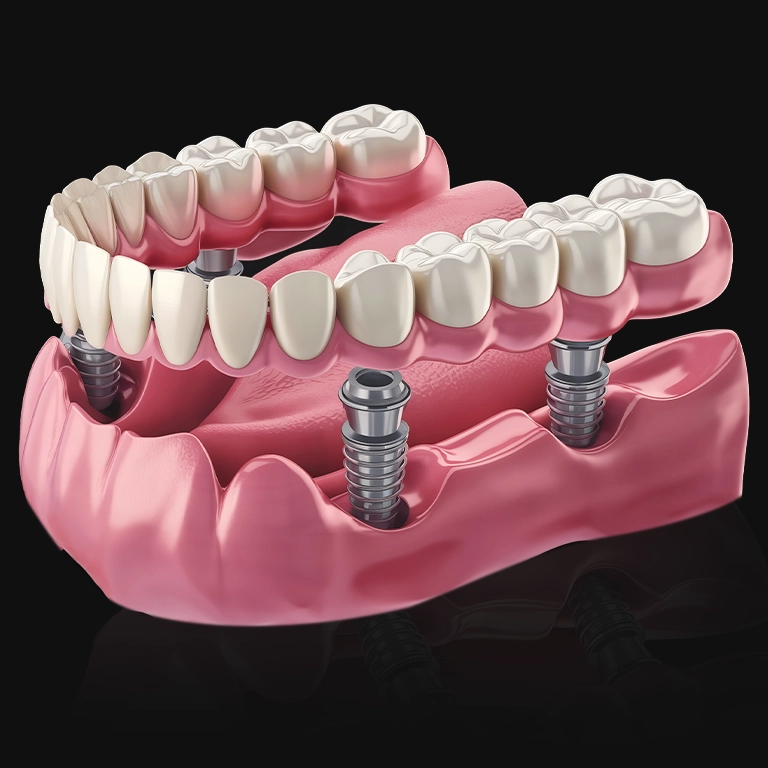 All on 4 Implants ın Turkey Istanbul