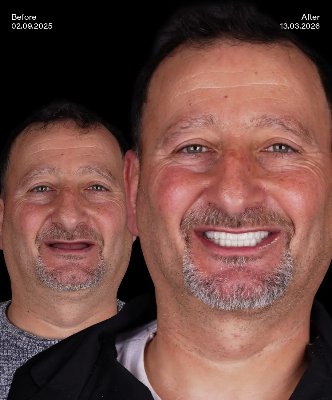 All on 4 Implants Before After 1