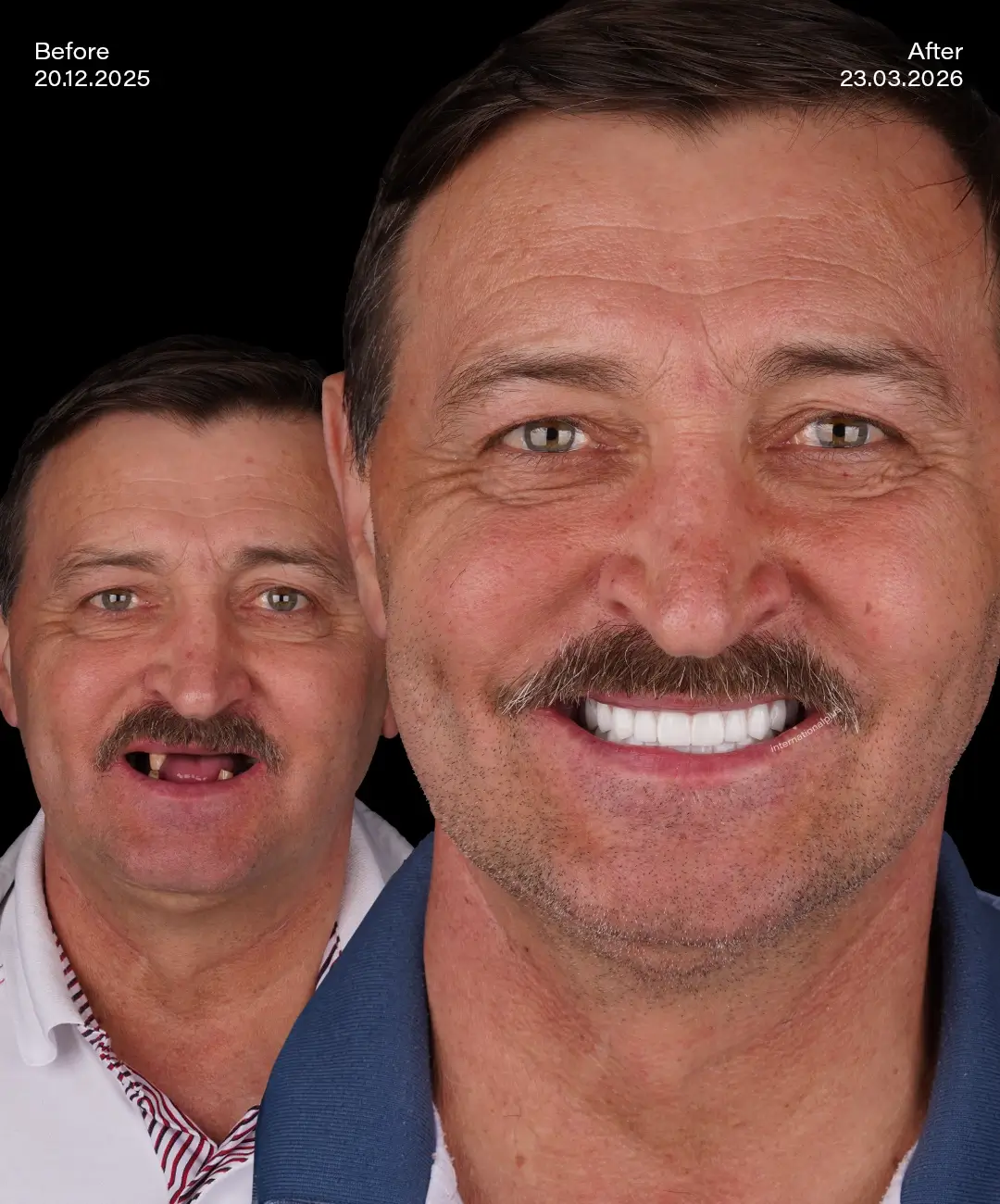 All on 4 Implants Before After 2