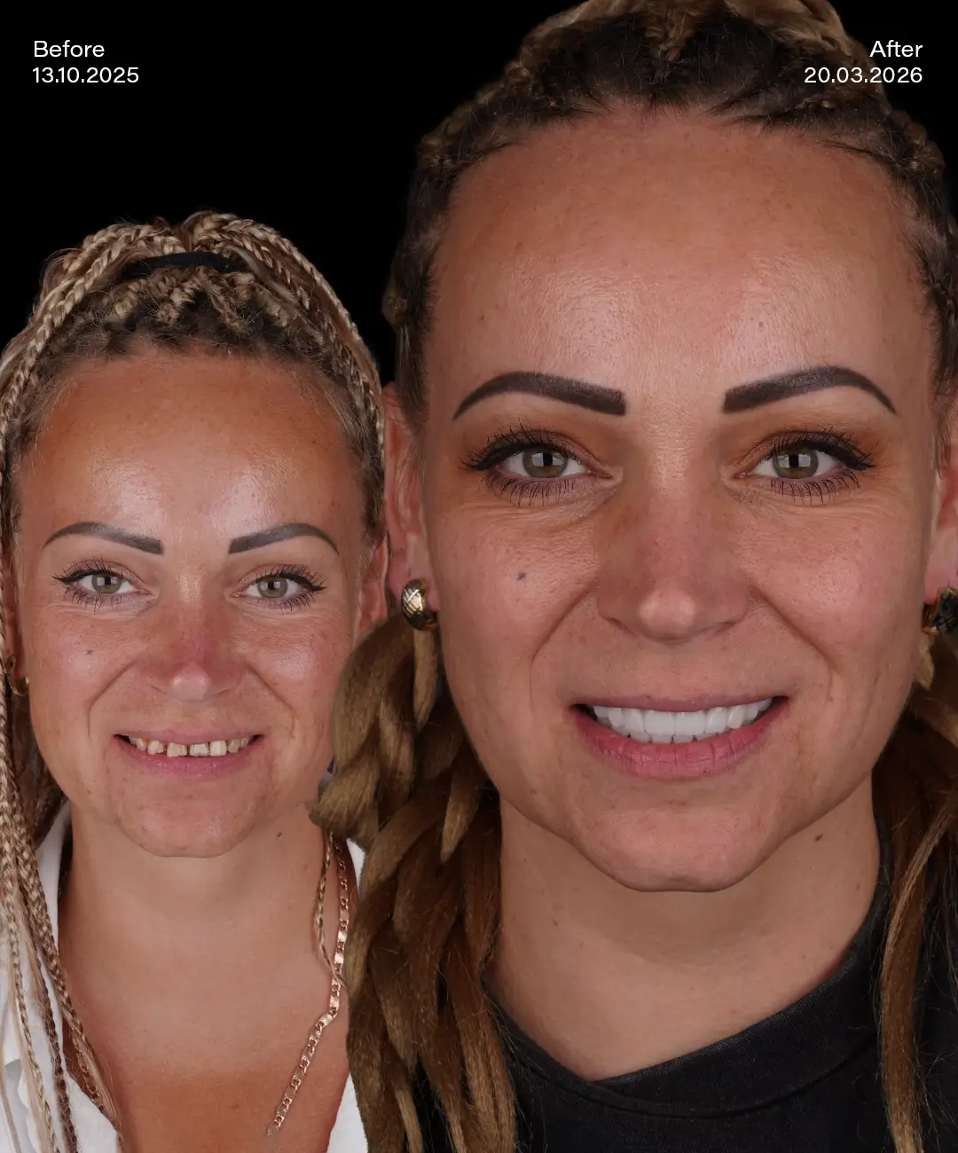 All on 4 Implants Before After 3