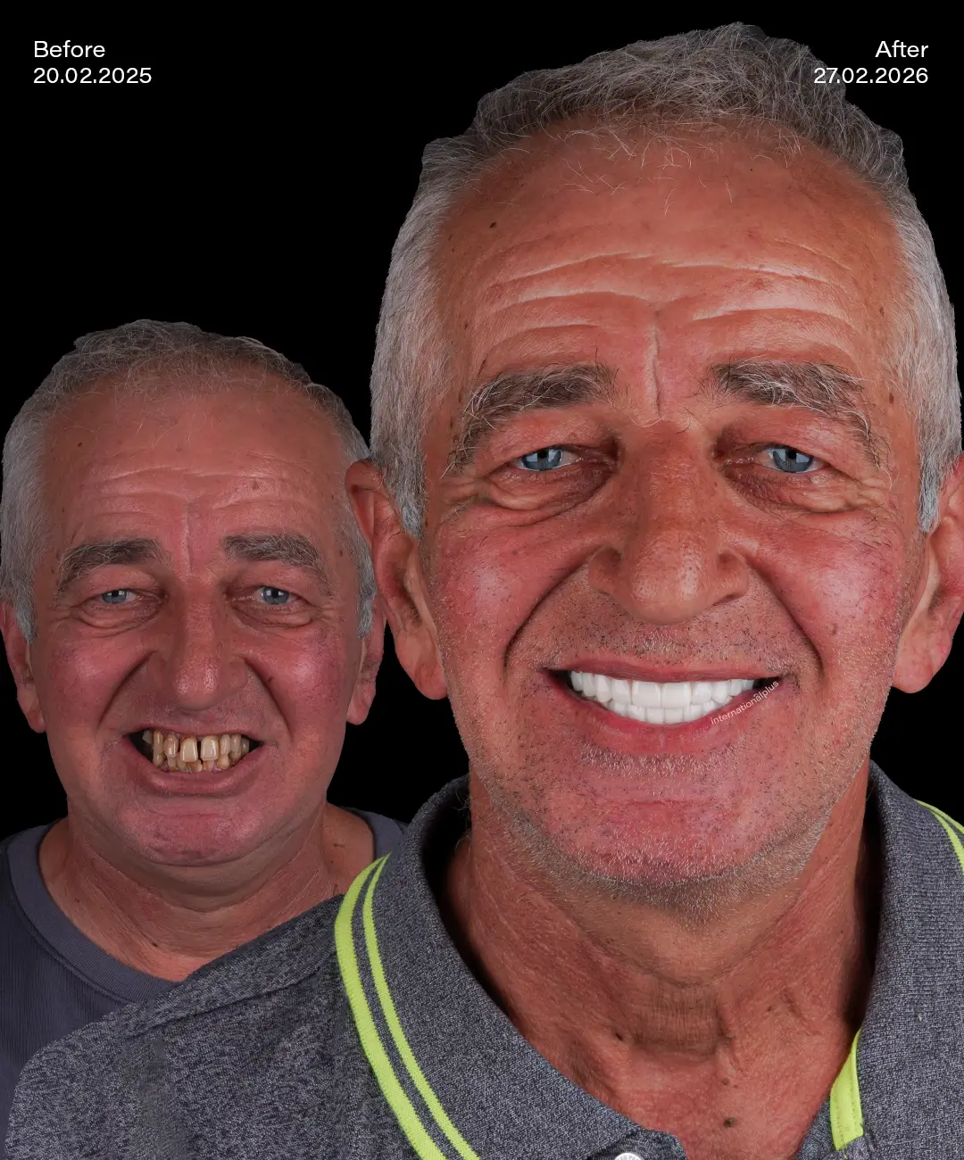 All on 4 Implants Before After 4