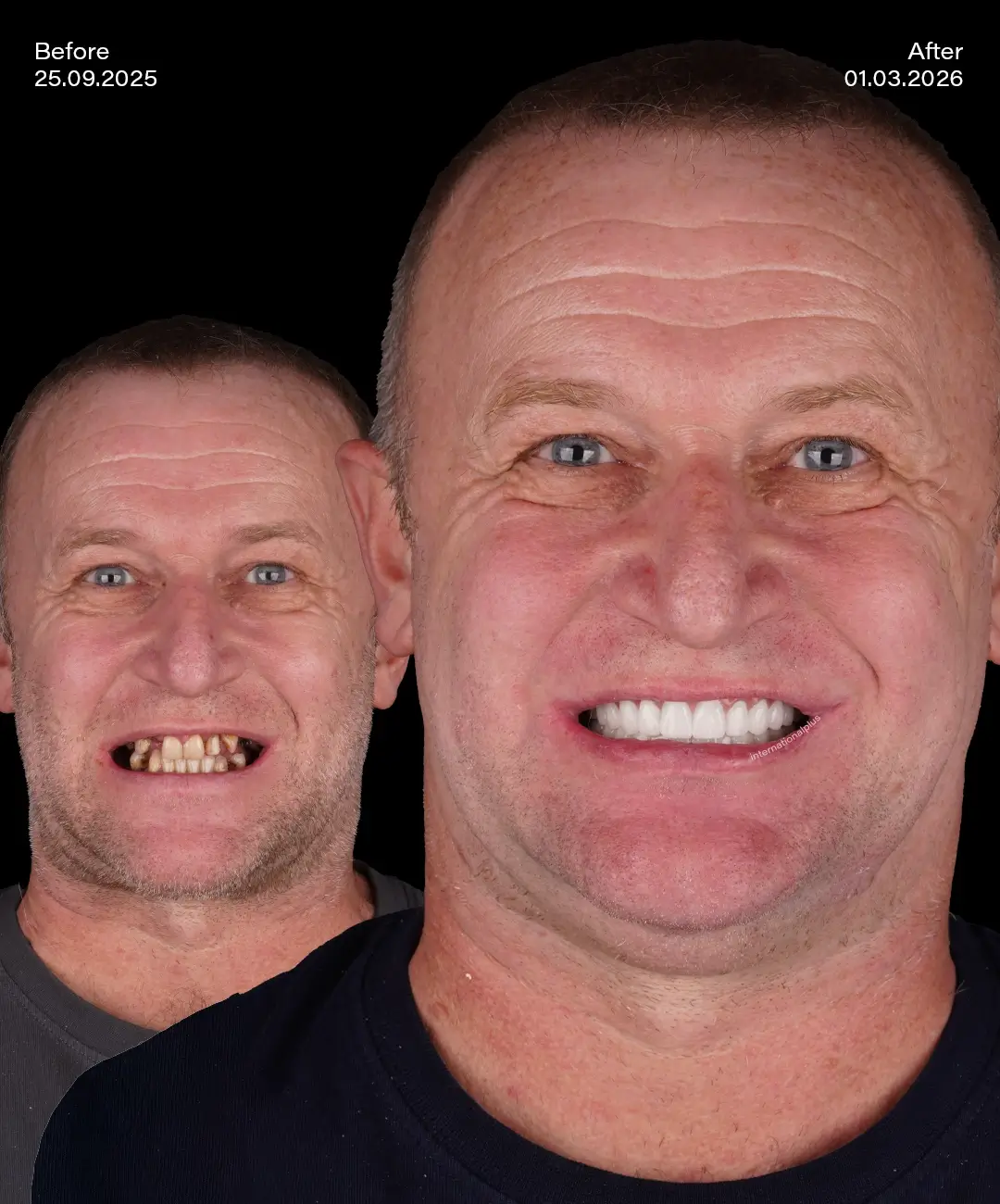 All on 4 Implants Before After 5