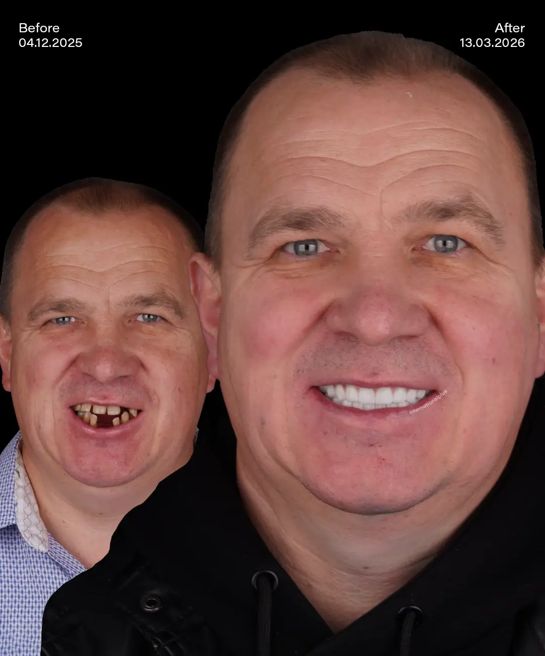 All on 4 Implants Before After 6