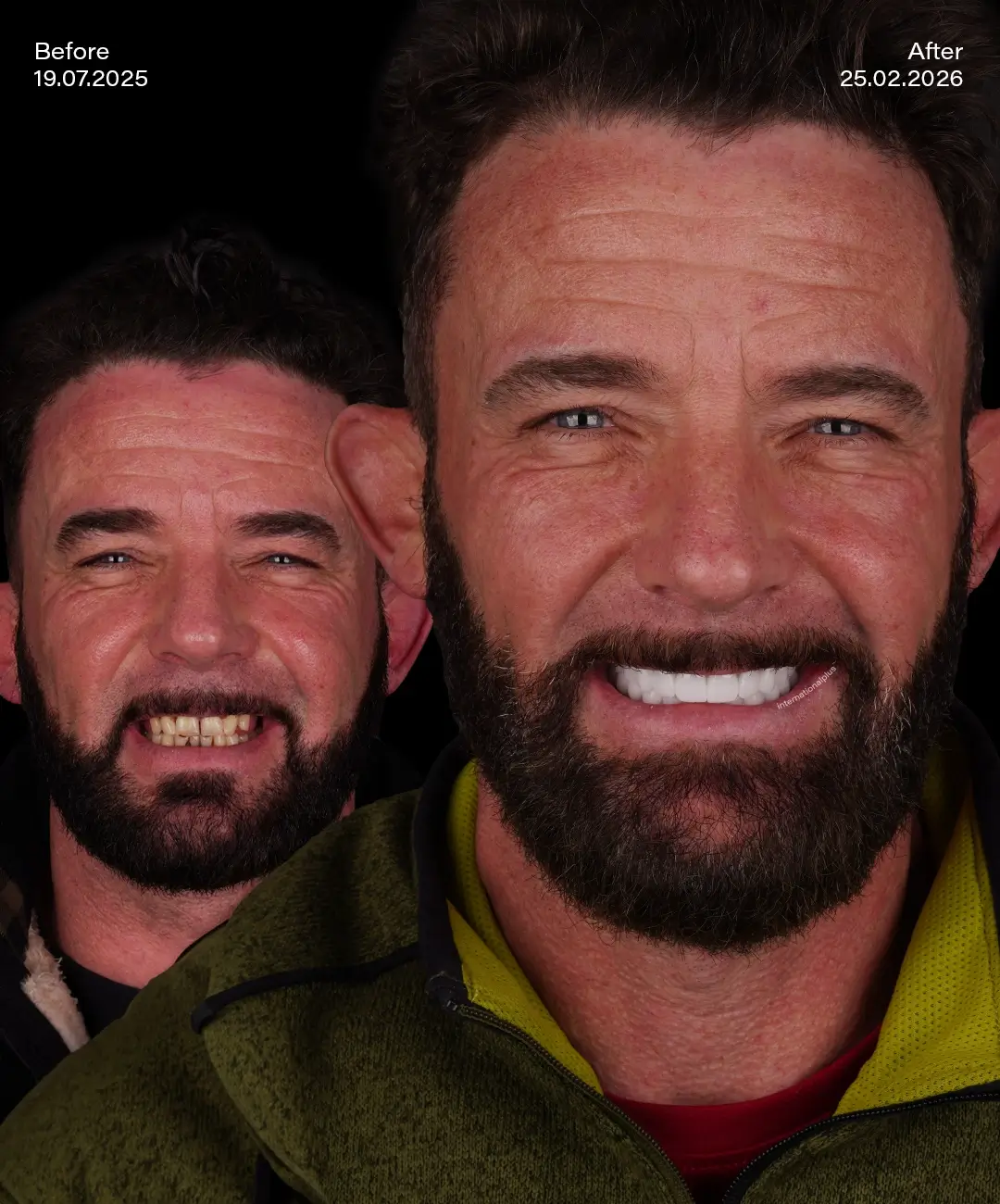 All on 4 Implants Before After 7