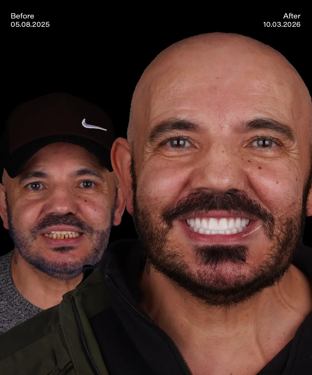 All on 4 Implants Before After 8