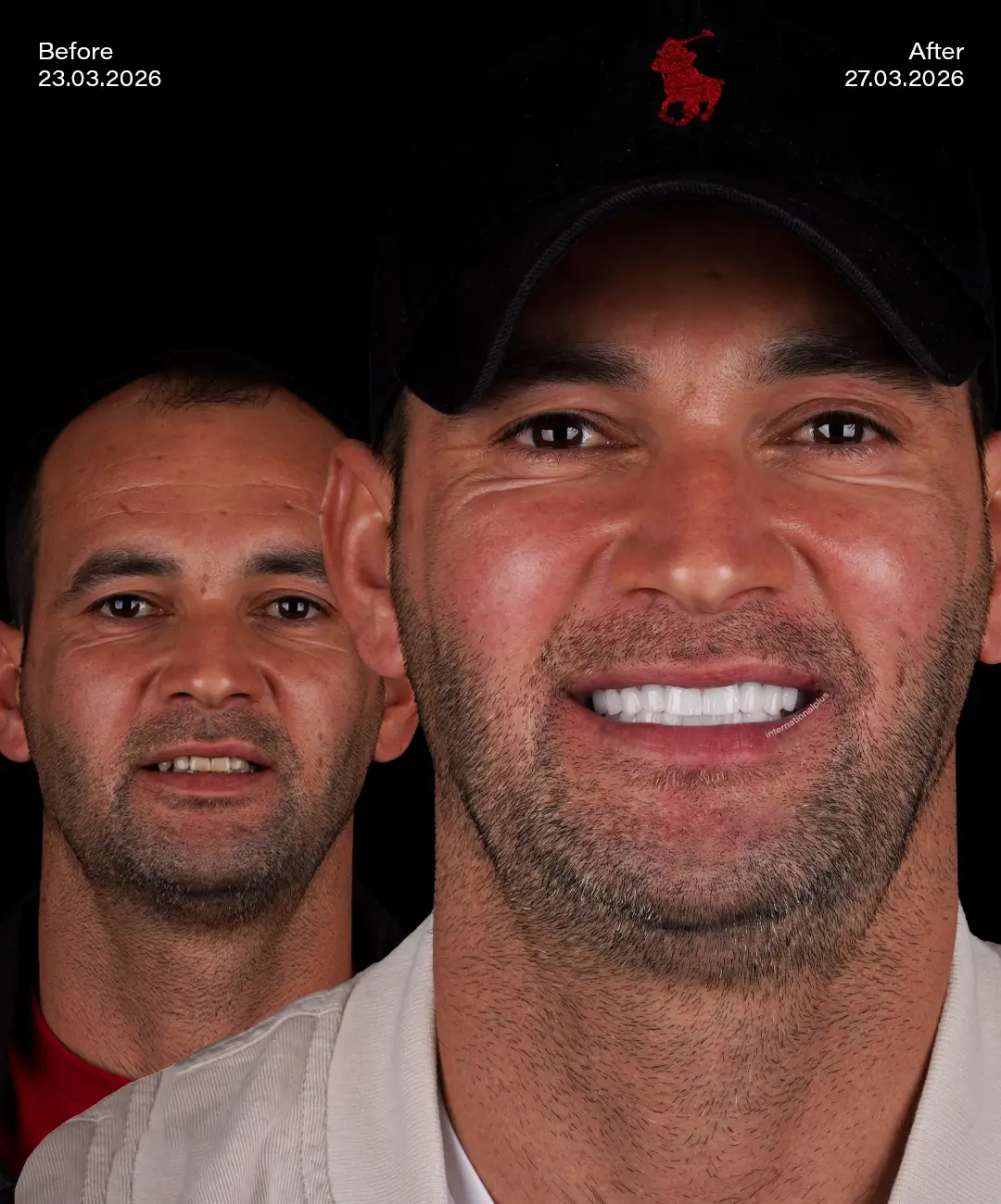 All on 6 Implants Before After 1