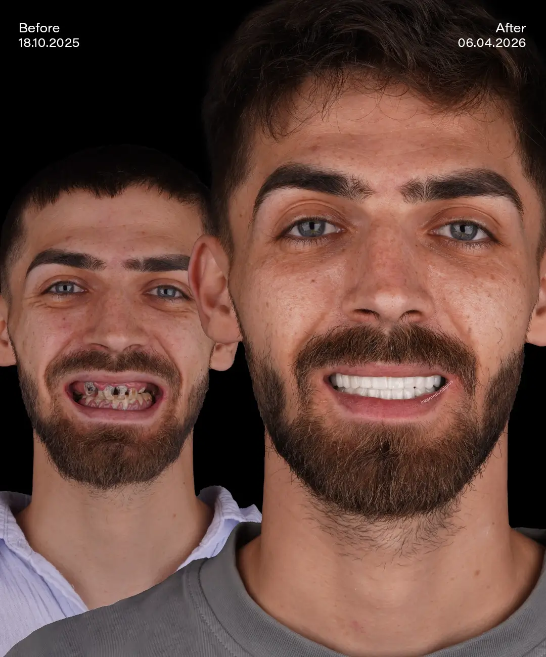 All on 6 Implants Before After 2