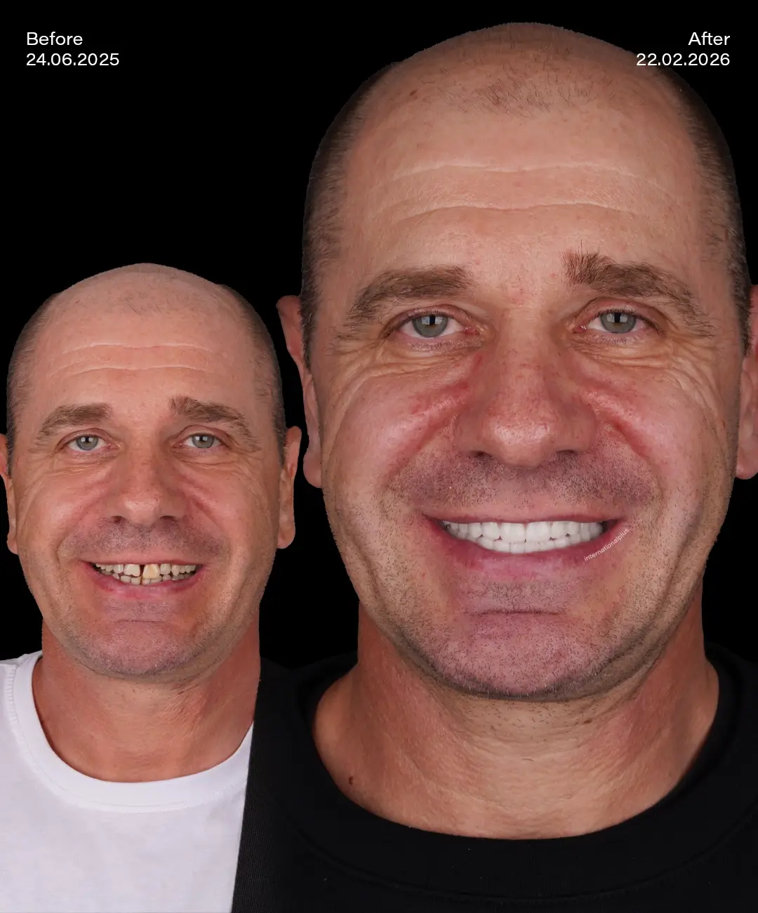 All on 6 Implants Before After 3