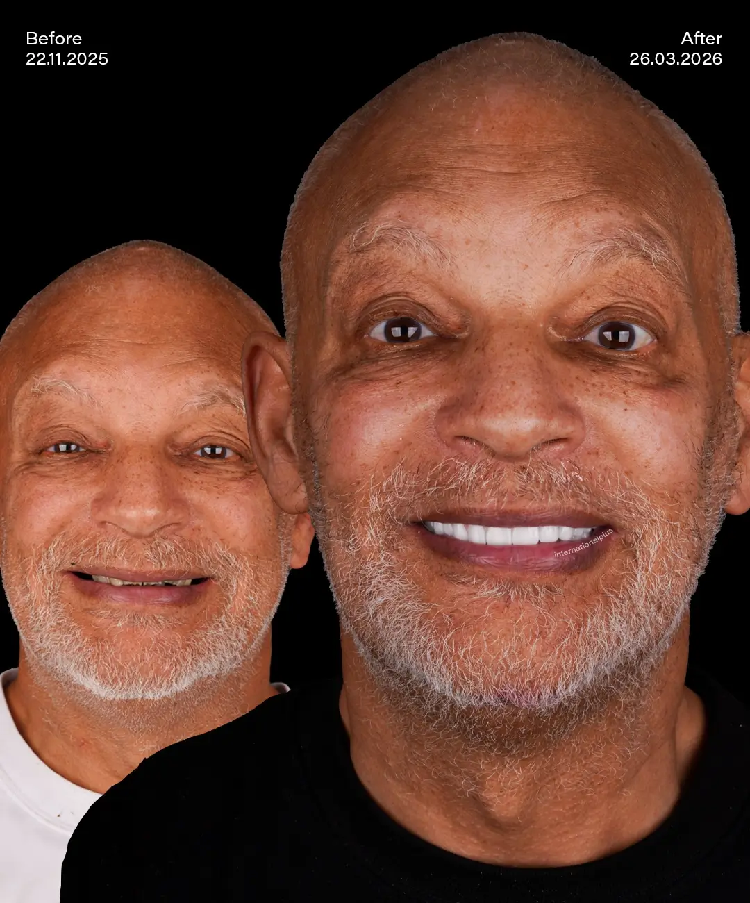 All on 6 Implants Before After 5