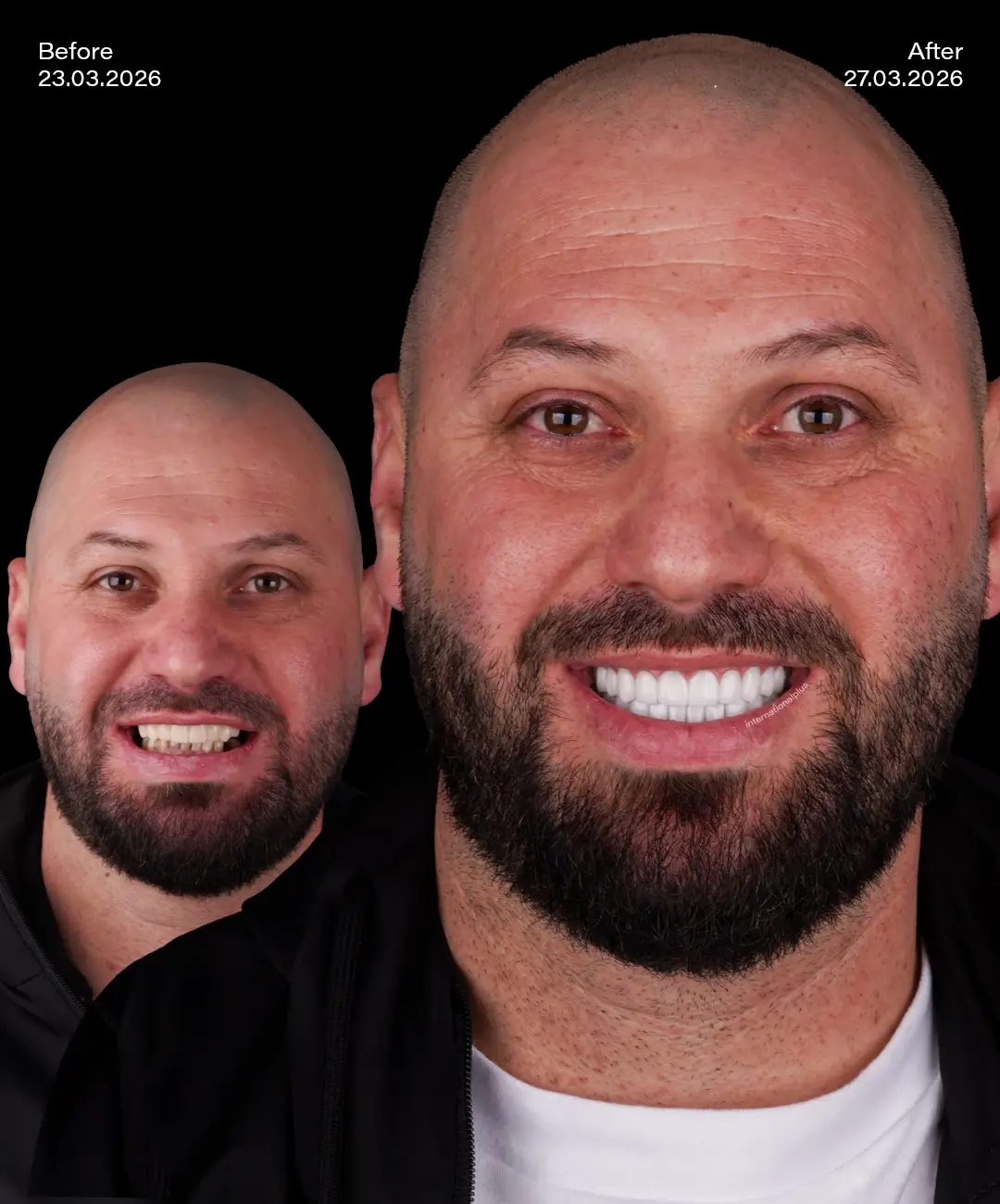 All on 6 Implants Before After 6