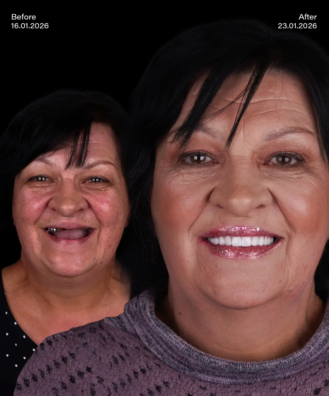 All on 6 Implants Before After 8