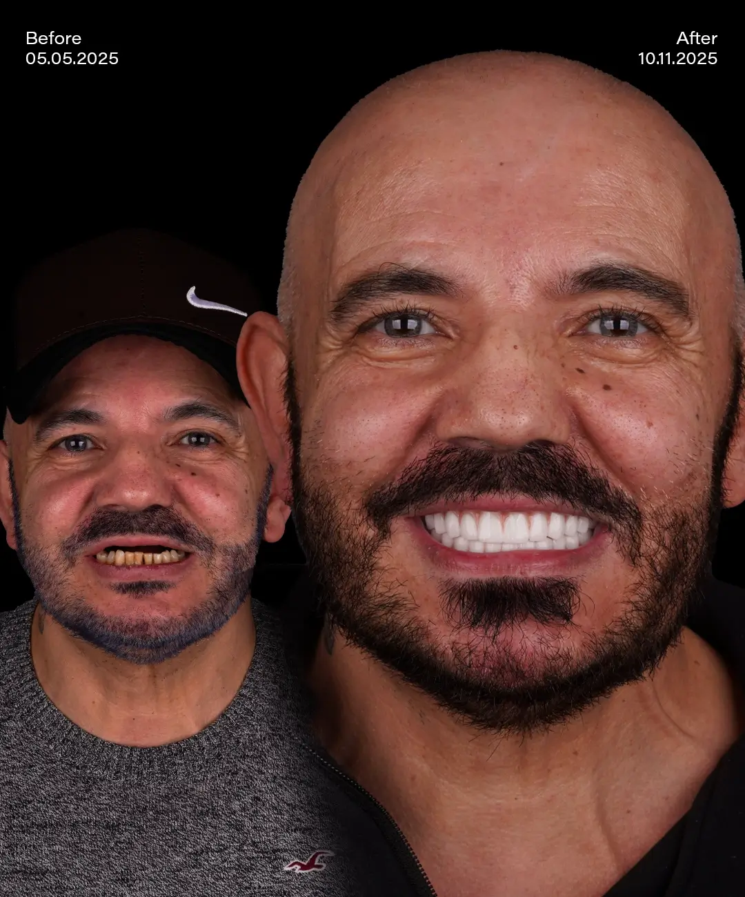 All on 6 Implants Before After 9