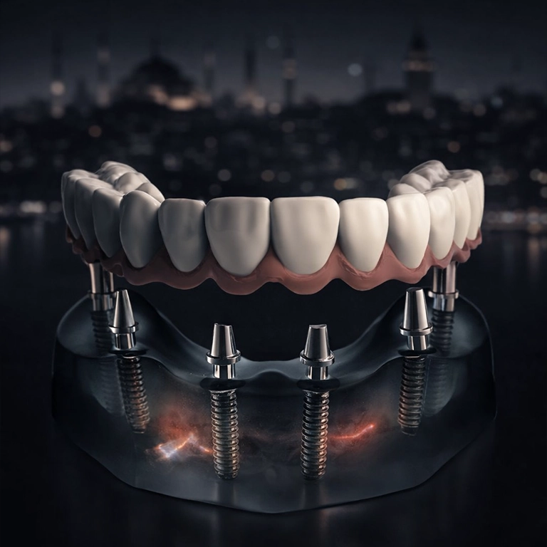 All on 6 Implants ın Turkey Istanbul