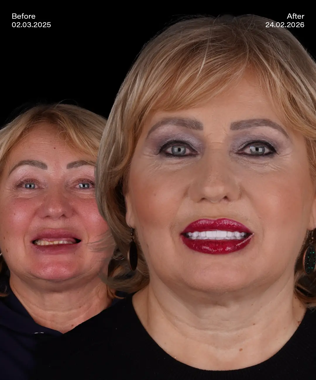 Custom Implant Before After 1