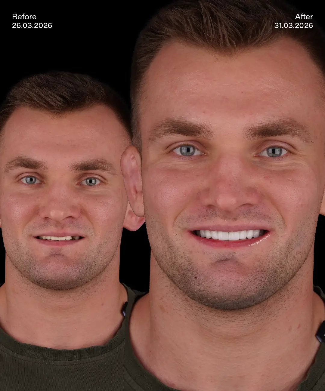 Dental Crowns Before After 1