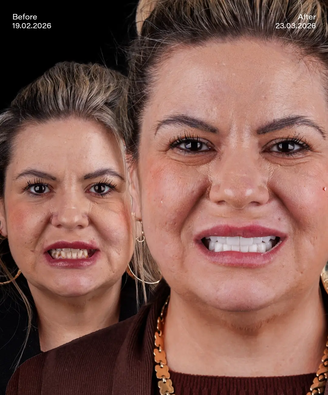 Dental Crowns Before After 2