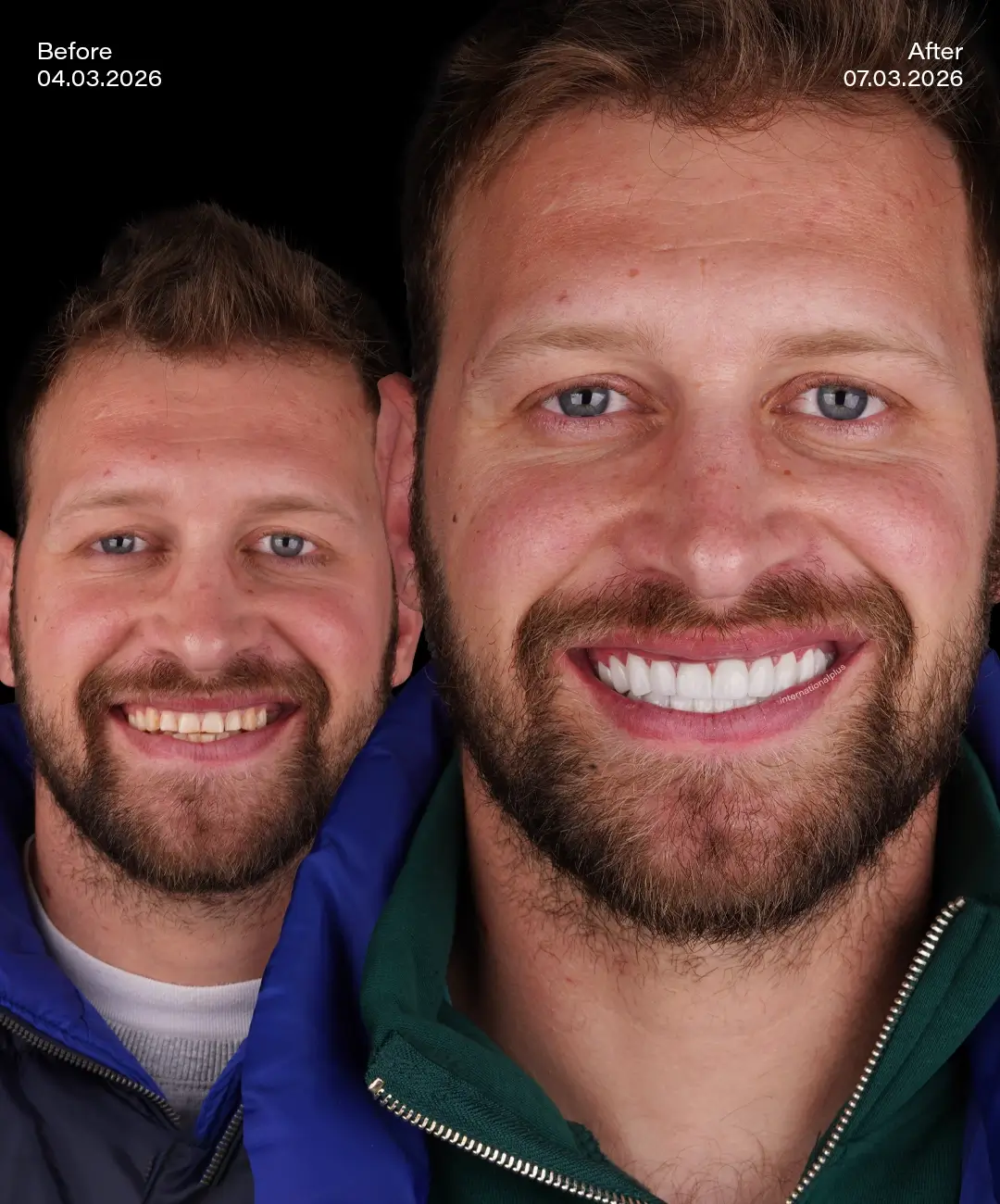 Dental Crowns Before After 3