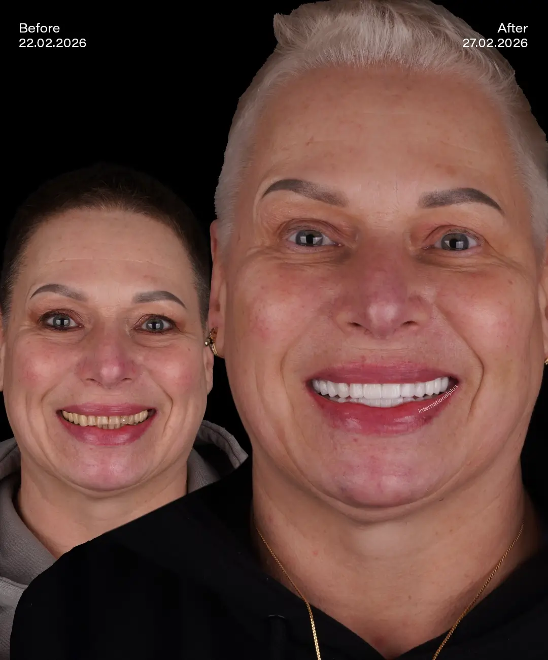 Dental Crowns Before After 4