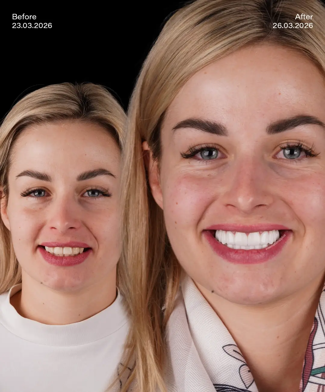 Dental Crowns Before After 5