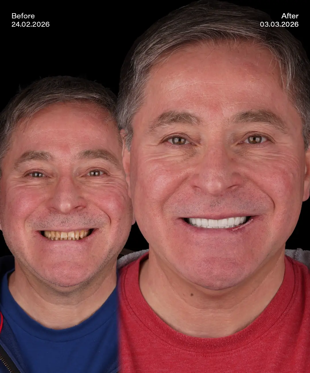 Dental Crowns Before After 6