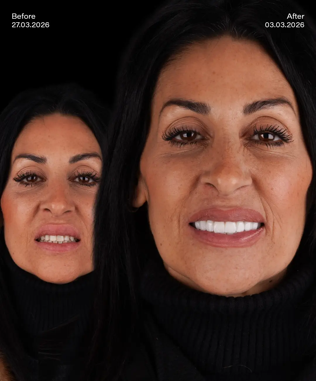 Dental Crowns Before After 7