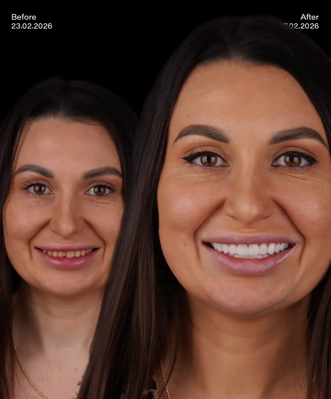 Dental Crowns Before After 8