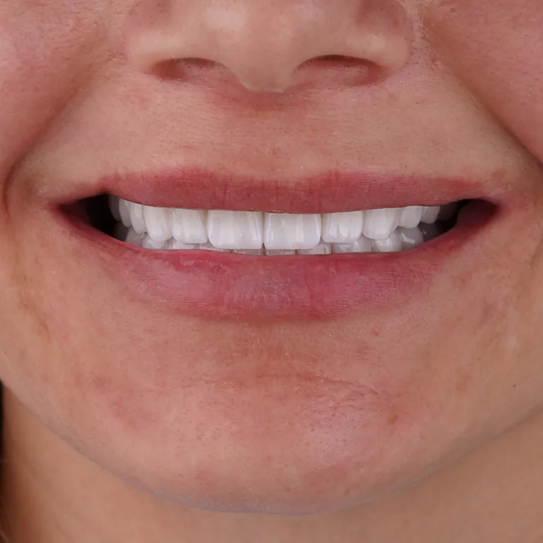Digital Dentistry From Temporary Teeth to Final Restoration