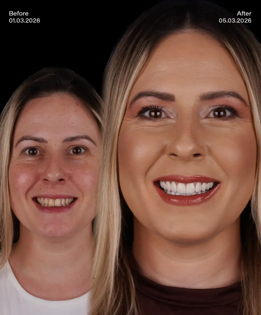 Digital Smile Desıgn Before After 1
