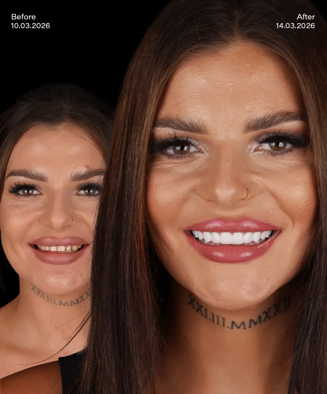 Digital Smile Desıgn Before After 2