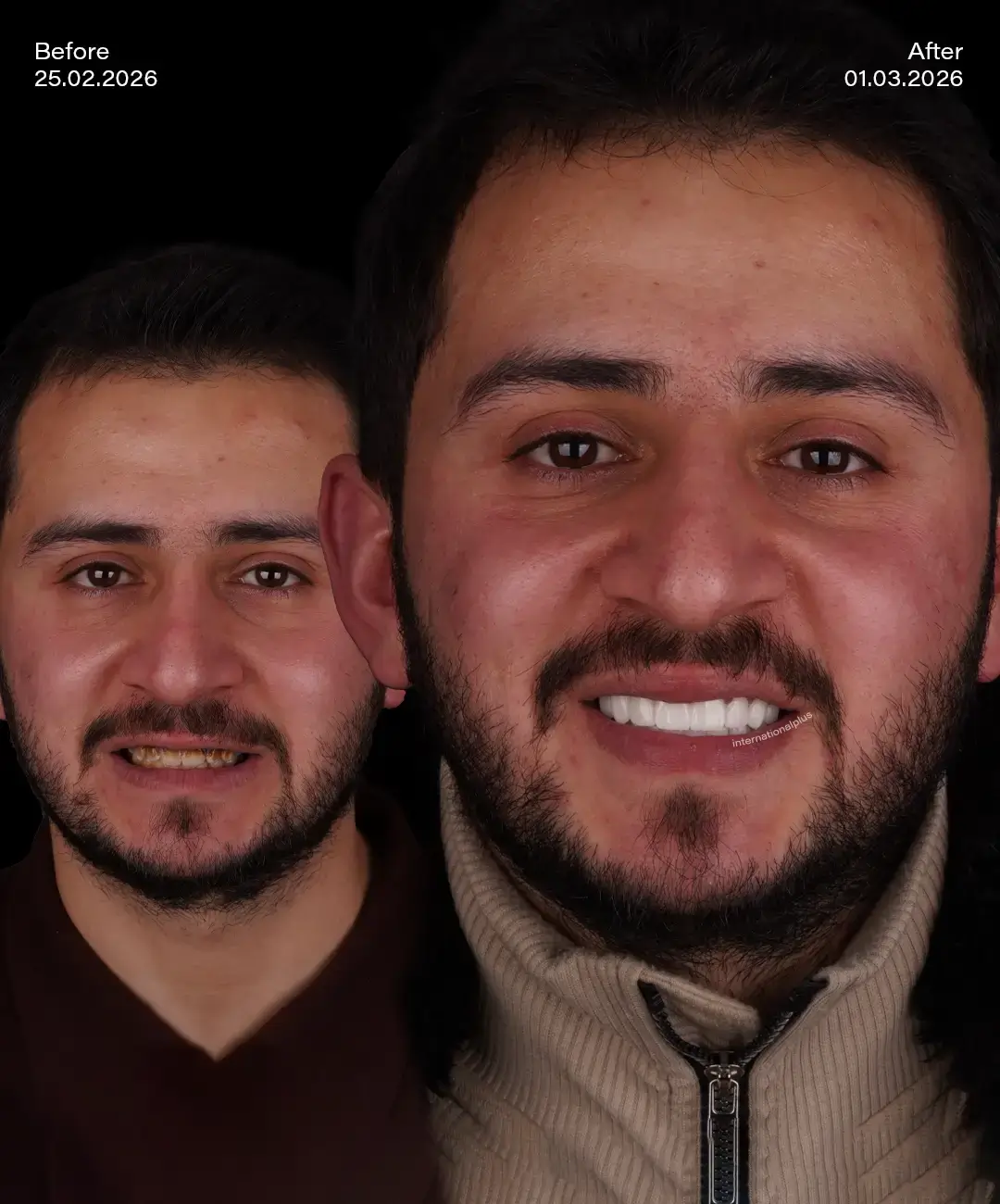 Digital Smile Desıgn Before After 3