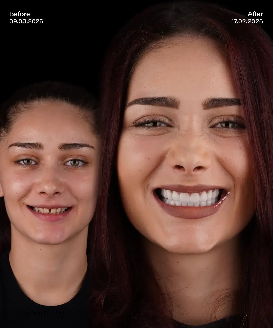 Digital Smile Desıgn Before After 4