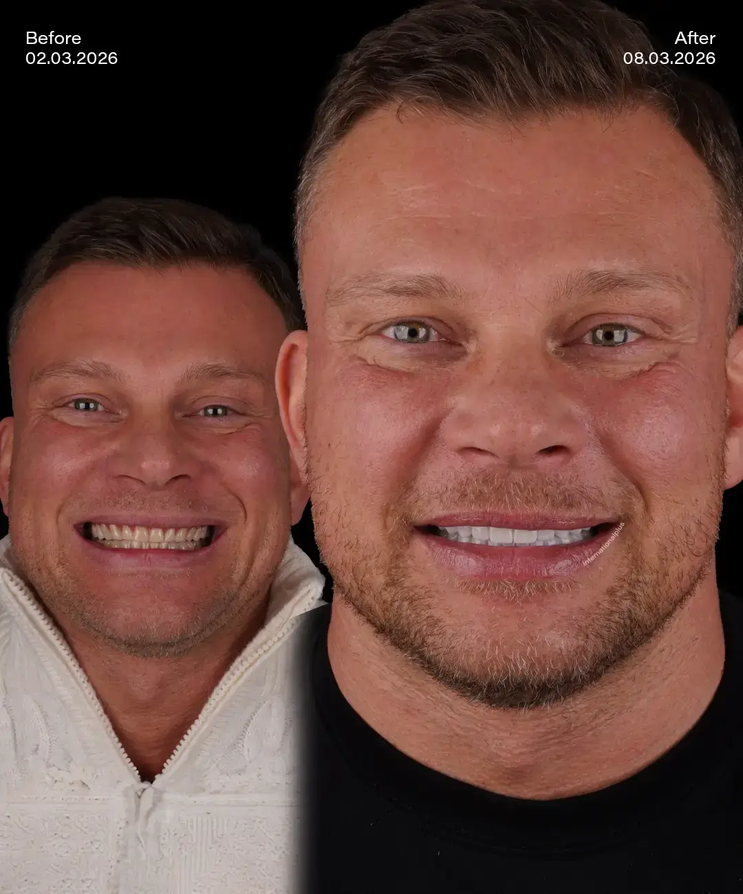 Digital Smile Desıgn Before After 5