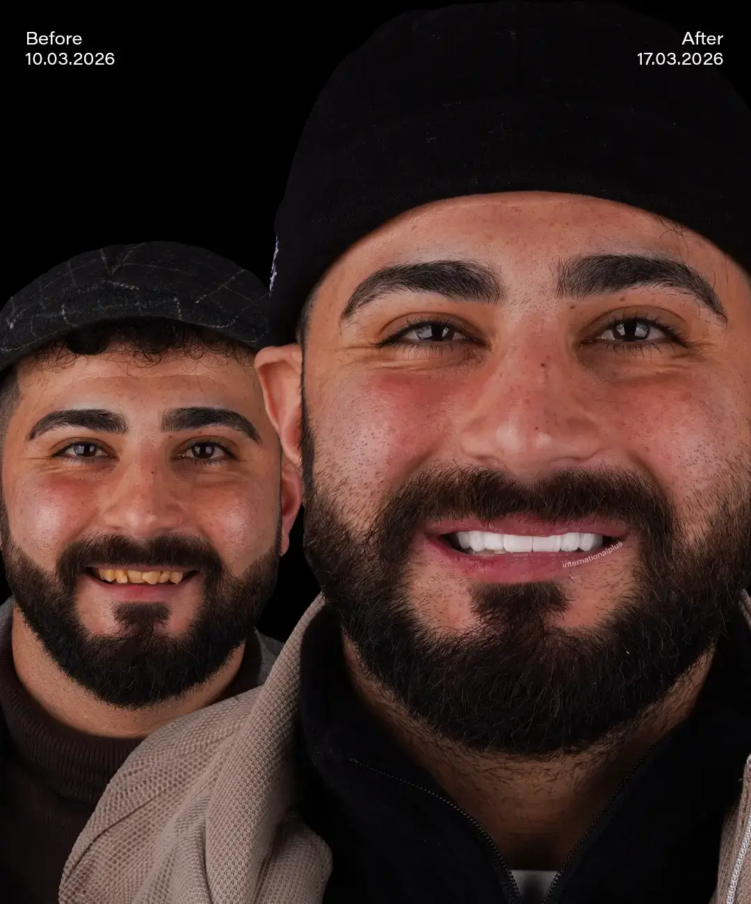 Digital Smile Desıgn Before After 6