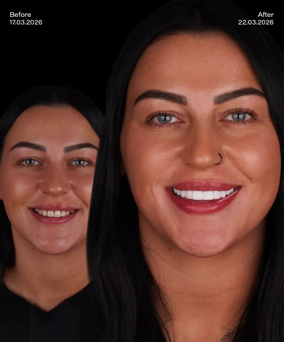 Digital Smile Desıgn Before After 7