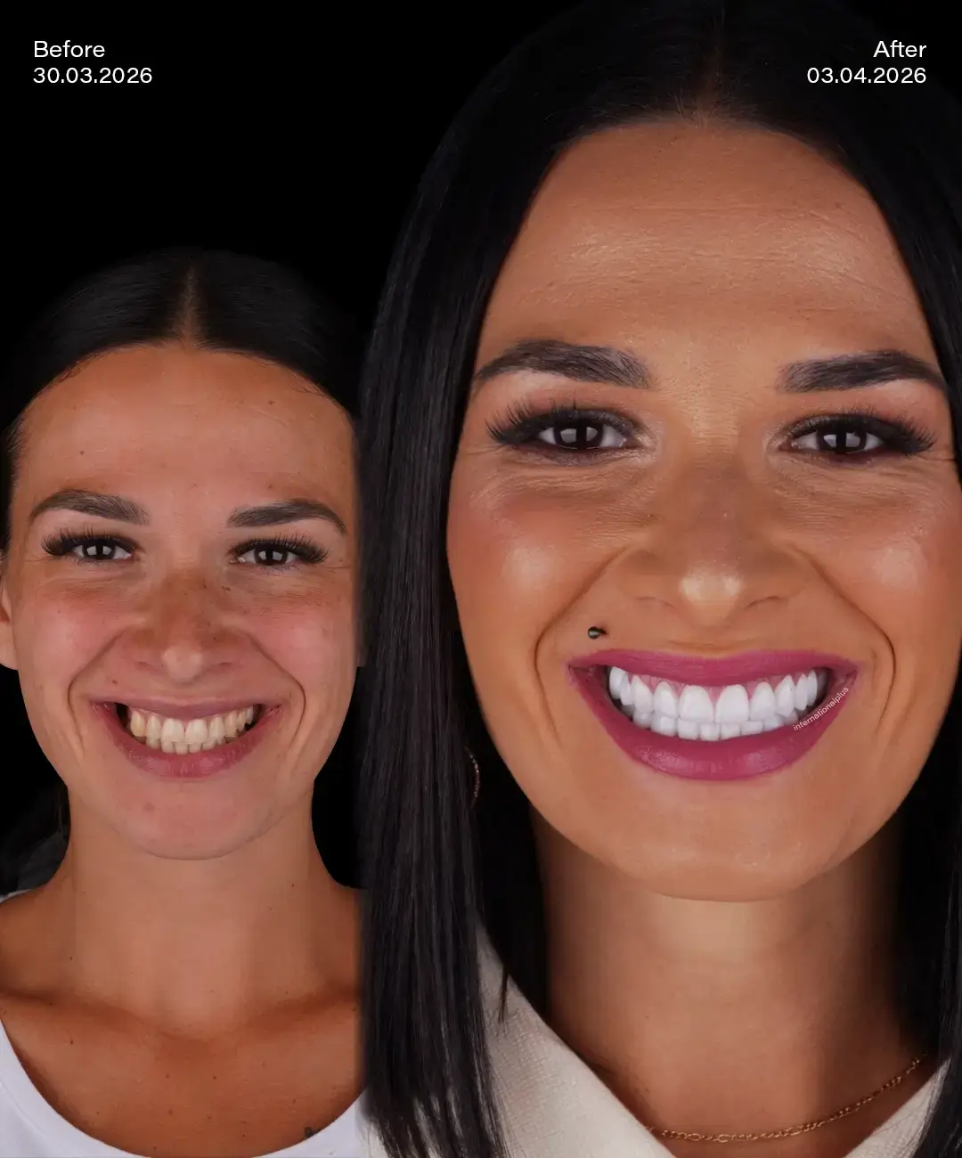 Digital Smile Desıgn Before After 8